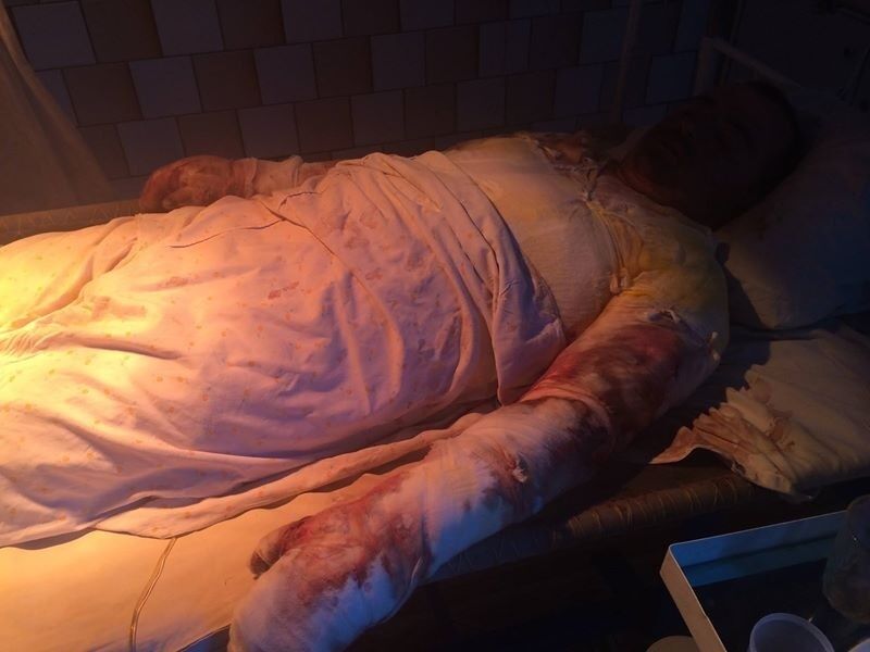 Снимки бойца с ожогами 75 процентов тела взорвали интернет. ''Если бы парню повезло и достался нормального качества комплект, он не лежал бы сейчас в ожоговом отделении'',&nbsp;– считает Юрий Бирюков. Фото из личного архива Юрия Бирюкова