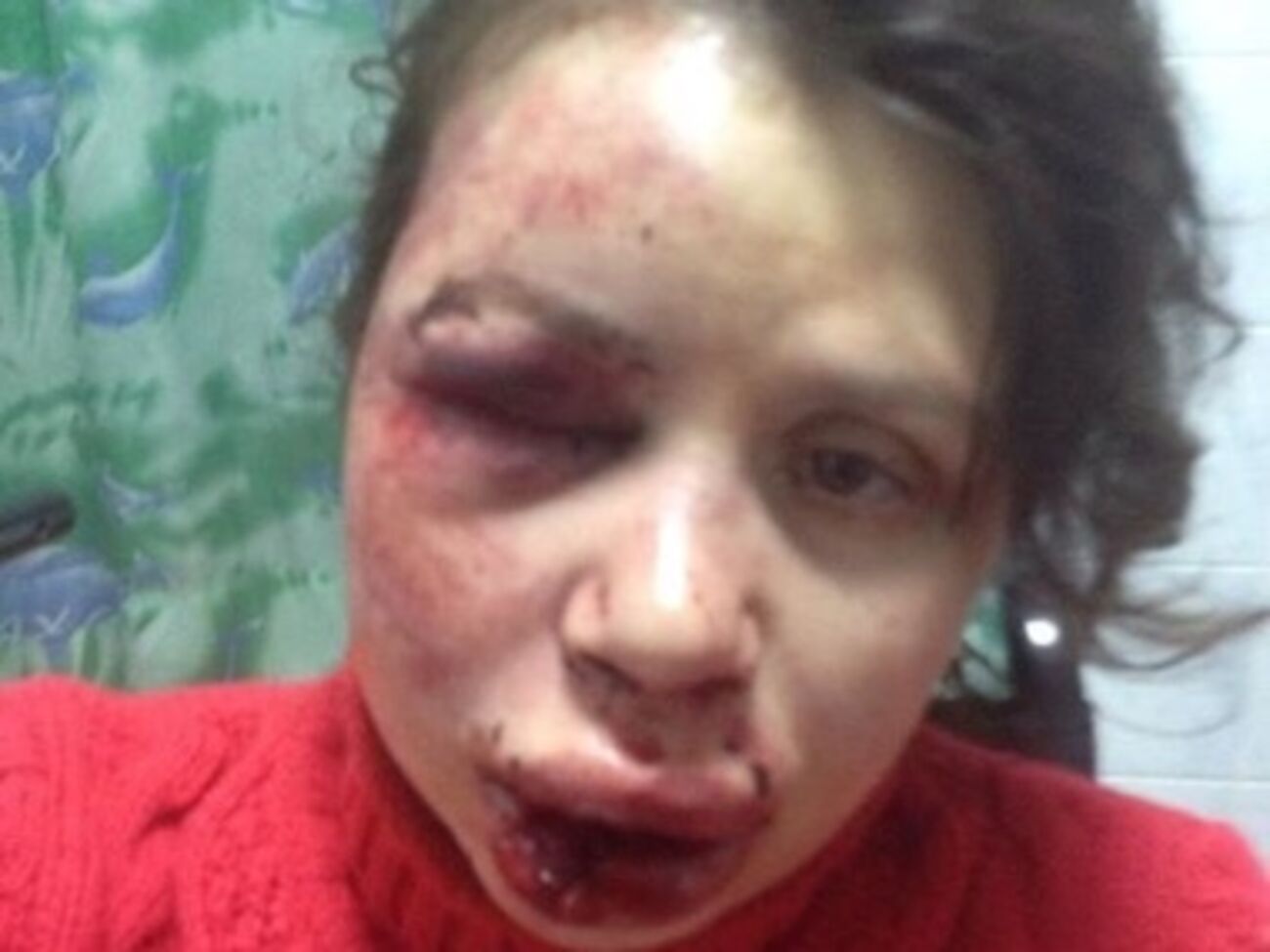 Черновол находится в травмпункте