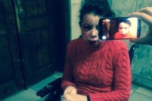 Татьяна Черновол после избиения