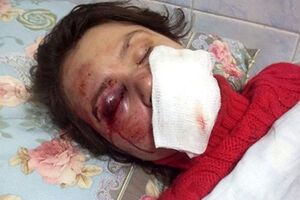 Татьяна Черновил после нападения