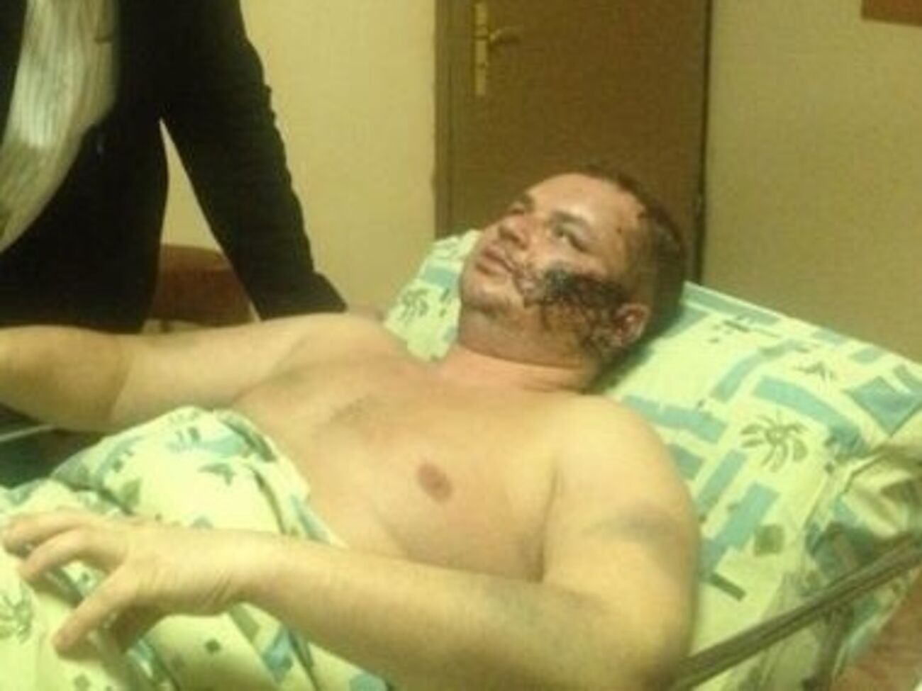 У Булатова множество травм