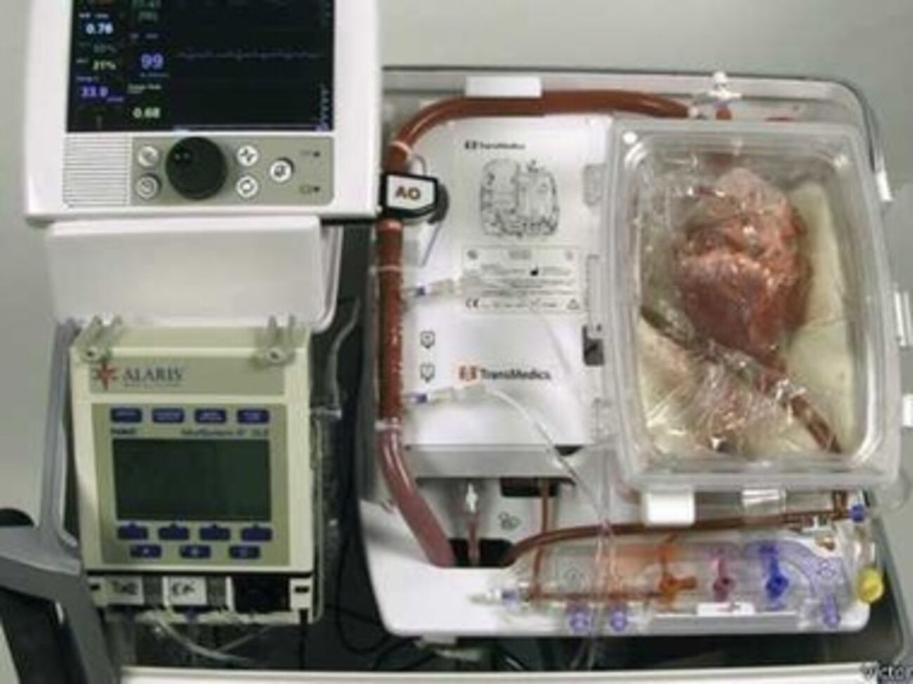 Хирурги пересадили сердце, которое не билось