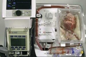 Хирурги пересадили сердце, которое не билось