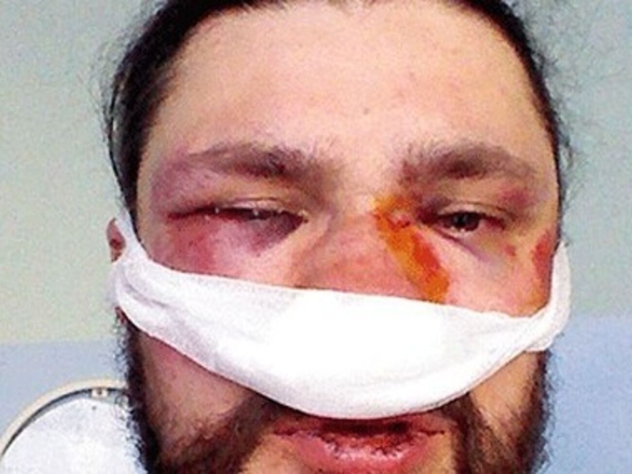 Украинские журналисты получили ранения в стычках с правоохранителями