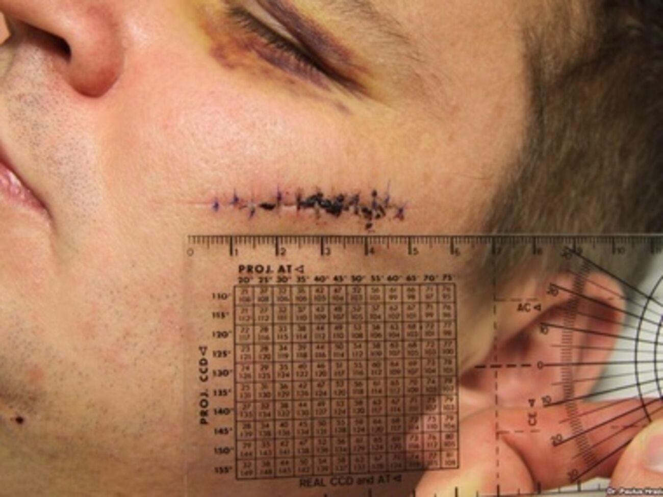 Врачи показали фото ранений лидера Автомайдана Булатова