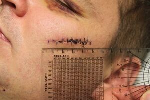 Врачи показали фото ранений лидера Автомайдана Булатова