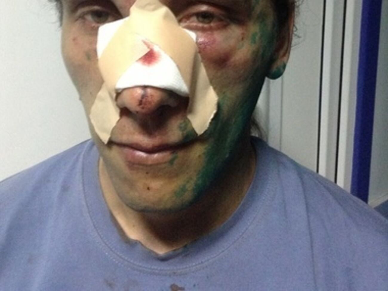 Один из пострадавших во время столкновения активистов Евромайдана и участников пророссийского митинга