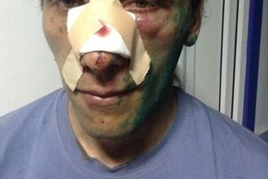 Один из пострадавших во время столкновения активистов Евромайдана и участников пророссийского митинга