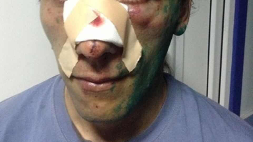 Один из пострадавших во время столкновения активистов Евромайдана и участников пророссийского митинга