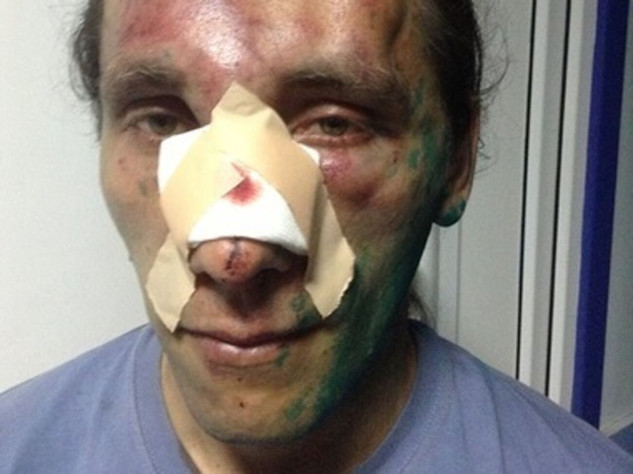 Сергея Мельника избили 6 апреля пророссийские активисты, напавшие на местный Евромайдан