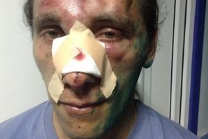 Сергея Мельника избили 6 апреля пророссийские активисты, напавшие на местный Евромайдан