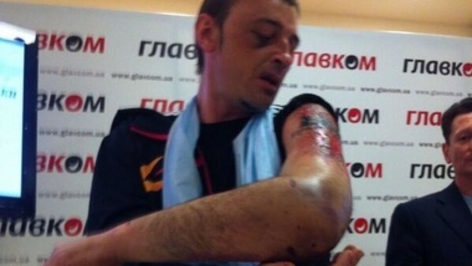 Александр Гуров показывает рану на месте татуировки