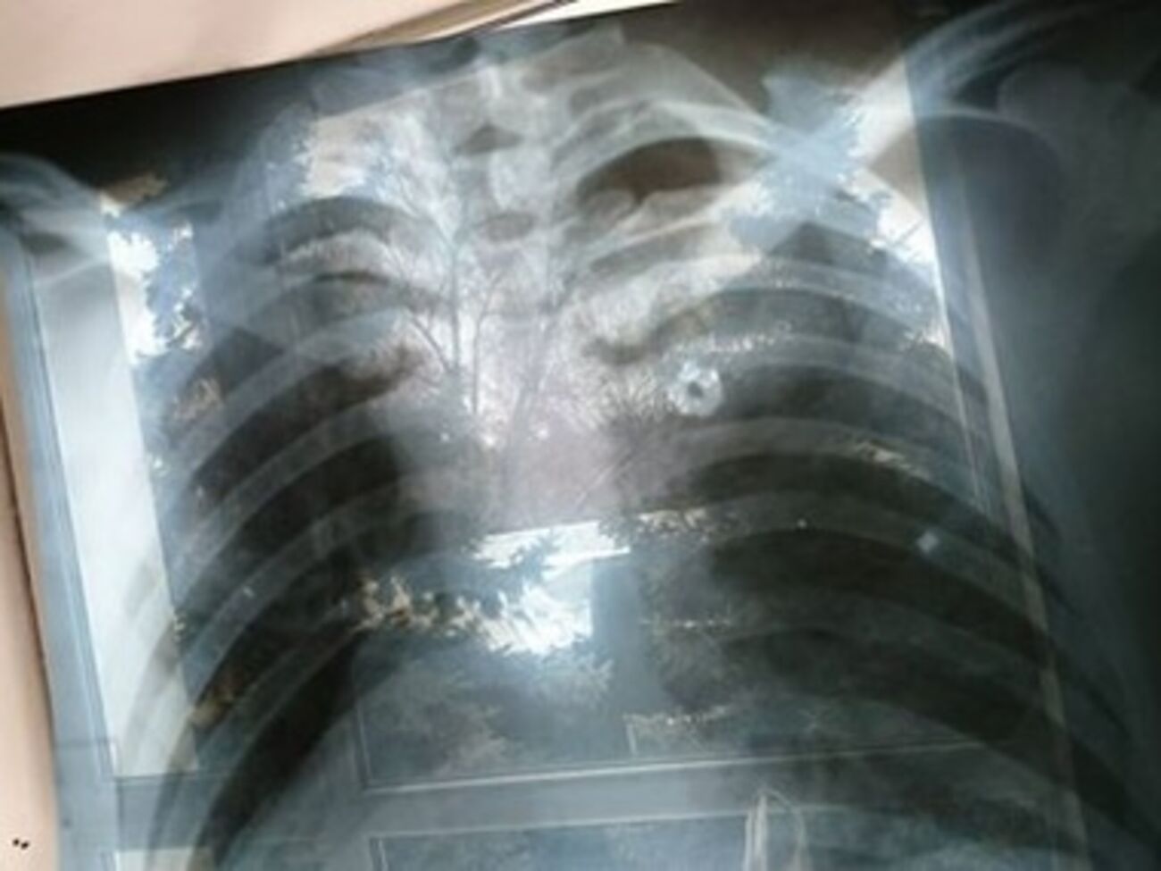 Рентгеновский снимок одного их пострадавших в результате теракта