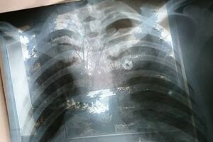 Рентгеновский снимок одного их пострадавших в результате теракта