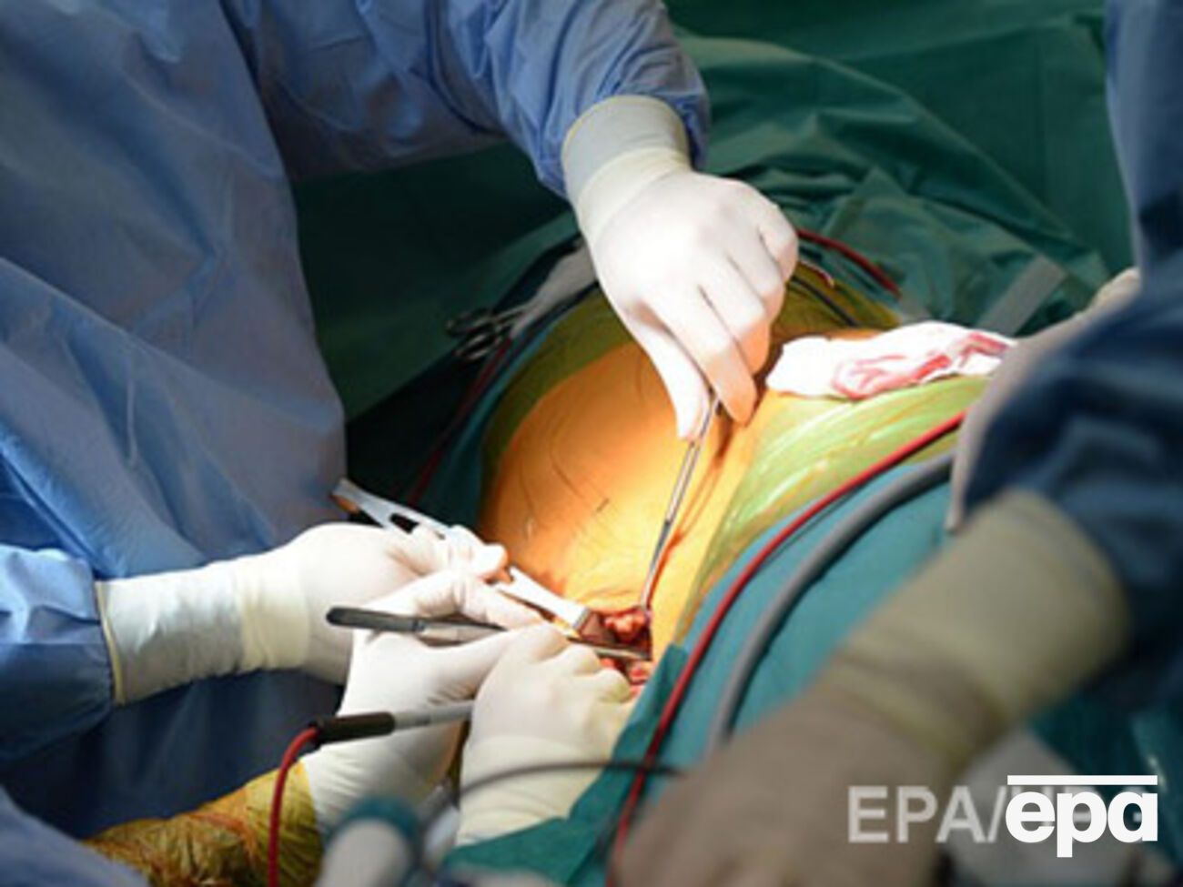 Преступники искали потенциальных доноров почек среди малообеспеченных граждан