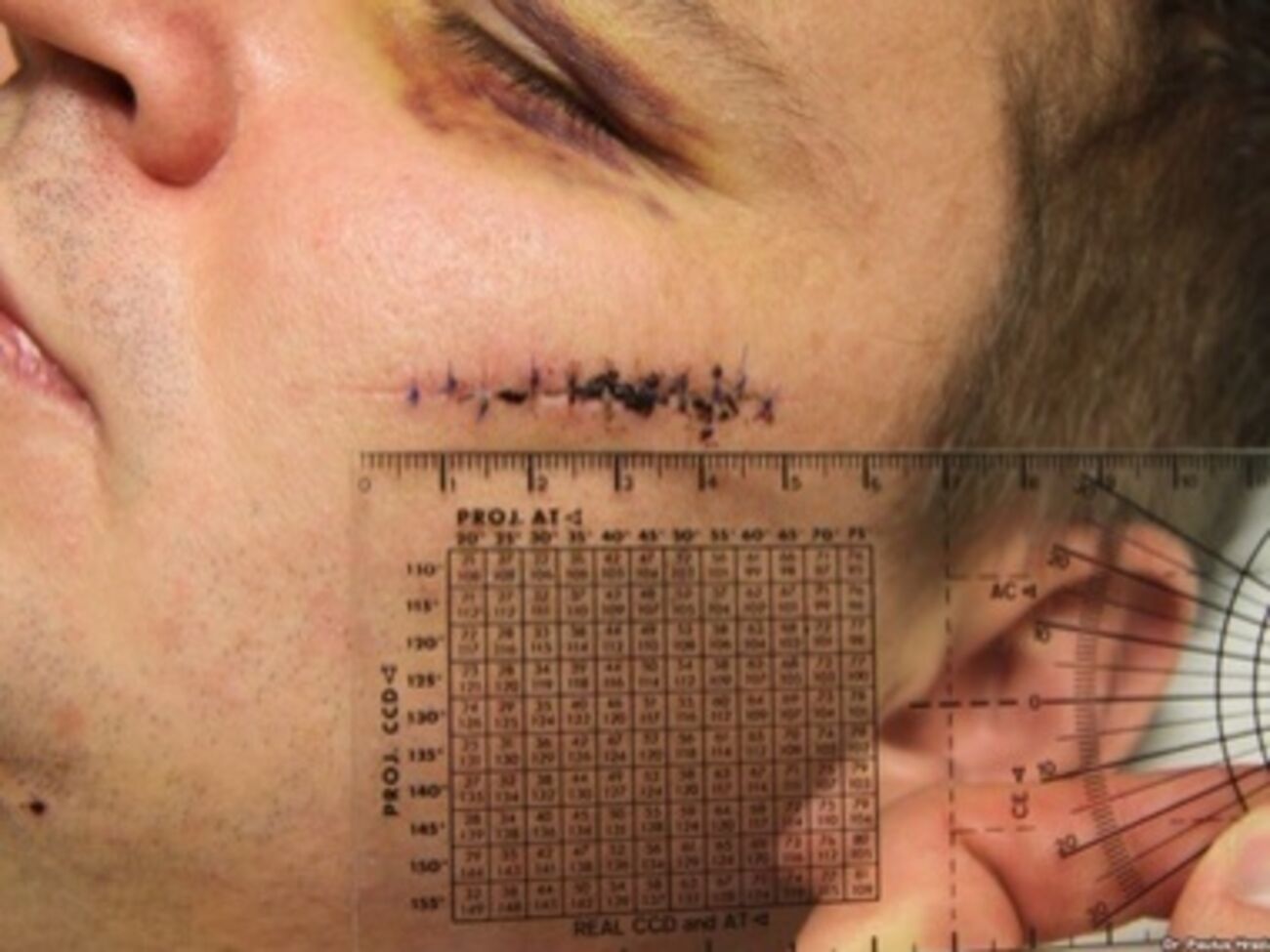 Литовский врач избитого Булатова Паулюс Градаускас передал "Радіо Свобода" фотографии травм, нанесенных активисту. На фото видны порезы на лице, отрезанный кусок уха и гематомы по всему телу