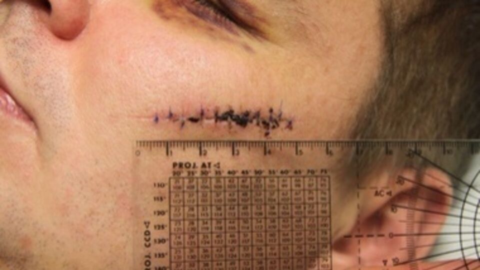 Литовский врач избитого Булатова Паулюс Градаускас передал "Радіо Свобода" фотографии травм, нанесенных активисту. На фото видны порезы на лице, отрезанный кусок уха и гематомы по всему телу