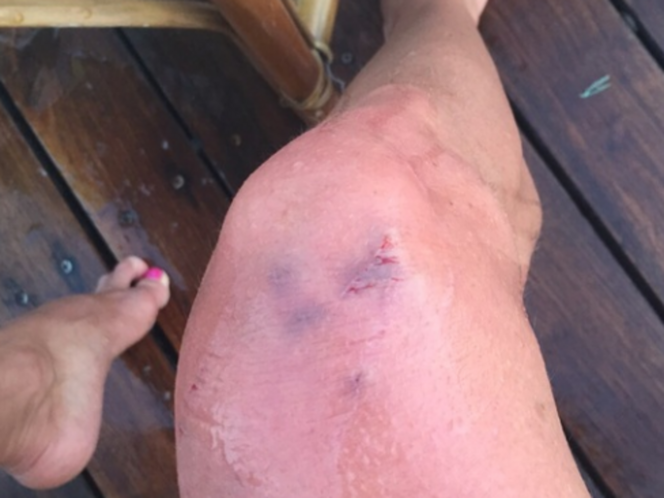 После укусов неизвестной рыбы Волочковой больно ходить