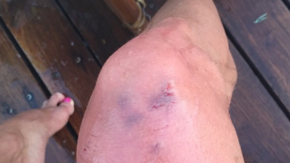 После укусов неизвестной рыбы Волочковой больно ходить