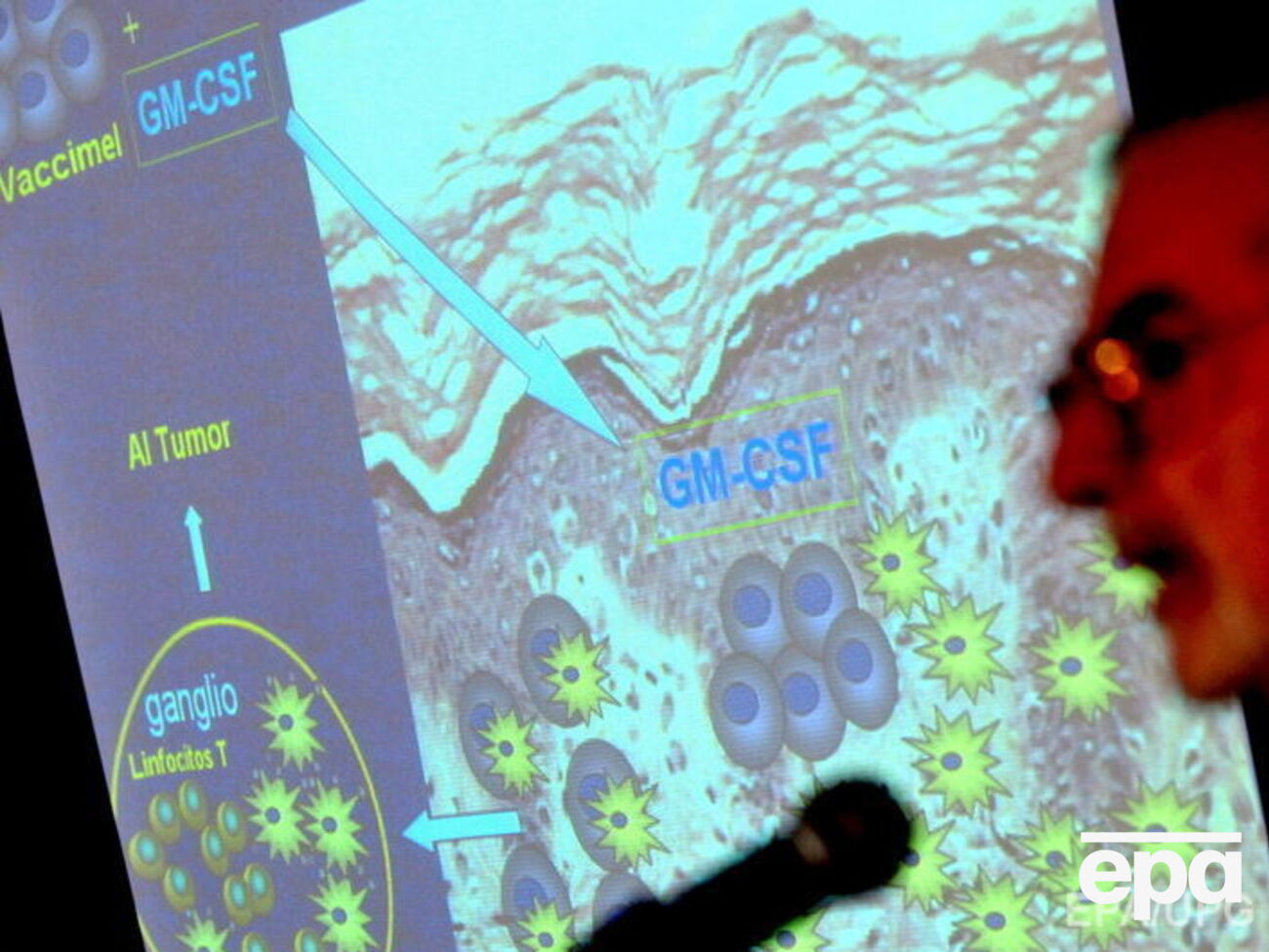 Вакцина остановила развитие меланомы у трех пациентов