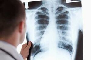 Синцов стверджує, що у 2016 році з 200 хворих 20 становили біженці з Донбасу