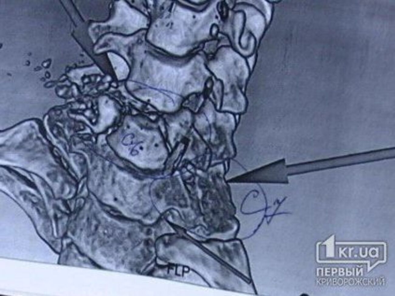 По словам Рыженко, пуля зацепила позвонок, разбила его на маленькие кусочки и перерезала спинномозговой канал