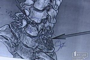 По словам Рыженко, пуля зацепила позвонок, разбила его на маленькие кусочки и перерезала спинномозговой канал