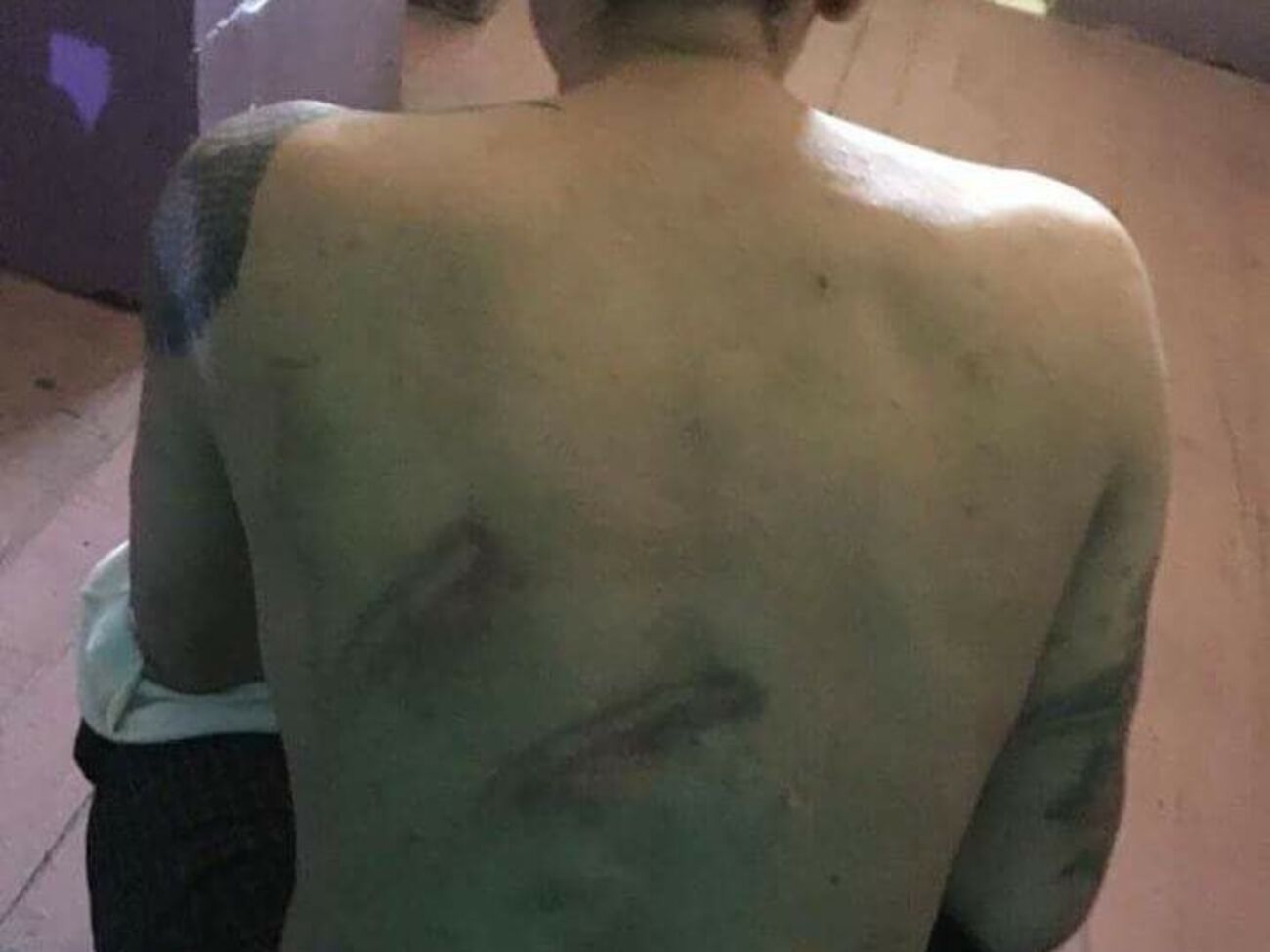 Фото спины с отеками, похожими на следы от дубинки, продемонстрировала омбудсмен