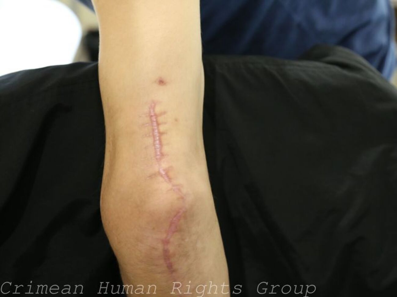 Костенко&nbsp;проходит реабилитацию после пыток в оккупированном Крыму