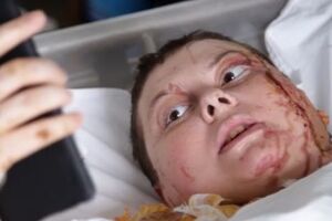 В июле Гандзюк облили серной кислотой