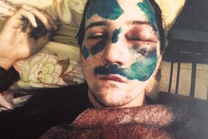 Владислав Цилицкий сразу после избиения в 2014 году (слева) и во время показаний в суде в 2018-м (справа)