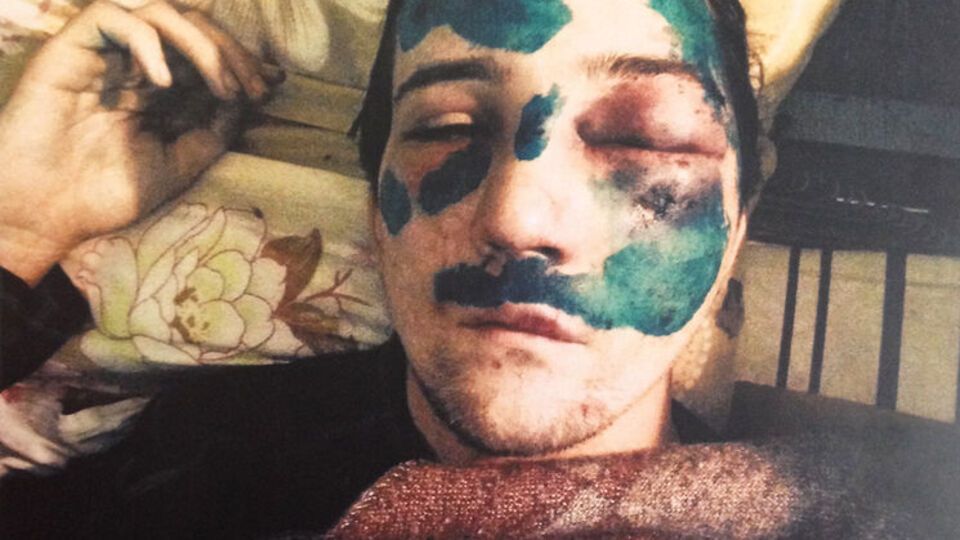 Владислав Цілицький одразу після побиття у 2014 році (ліворуч) і під час свідчень у суді у 2018-му (праворуч)