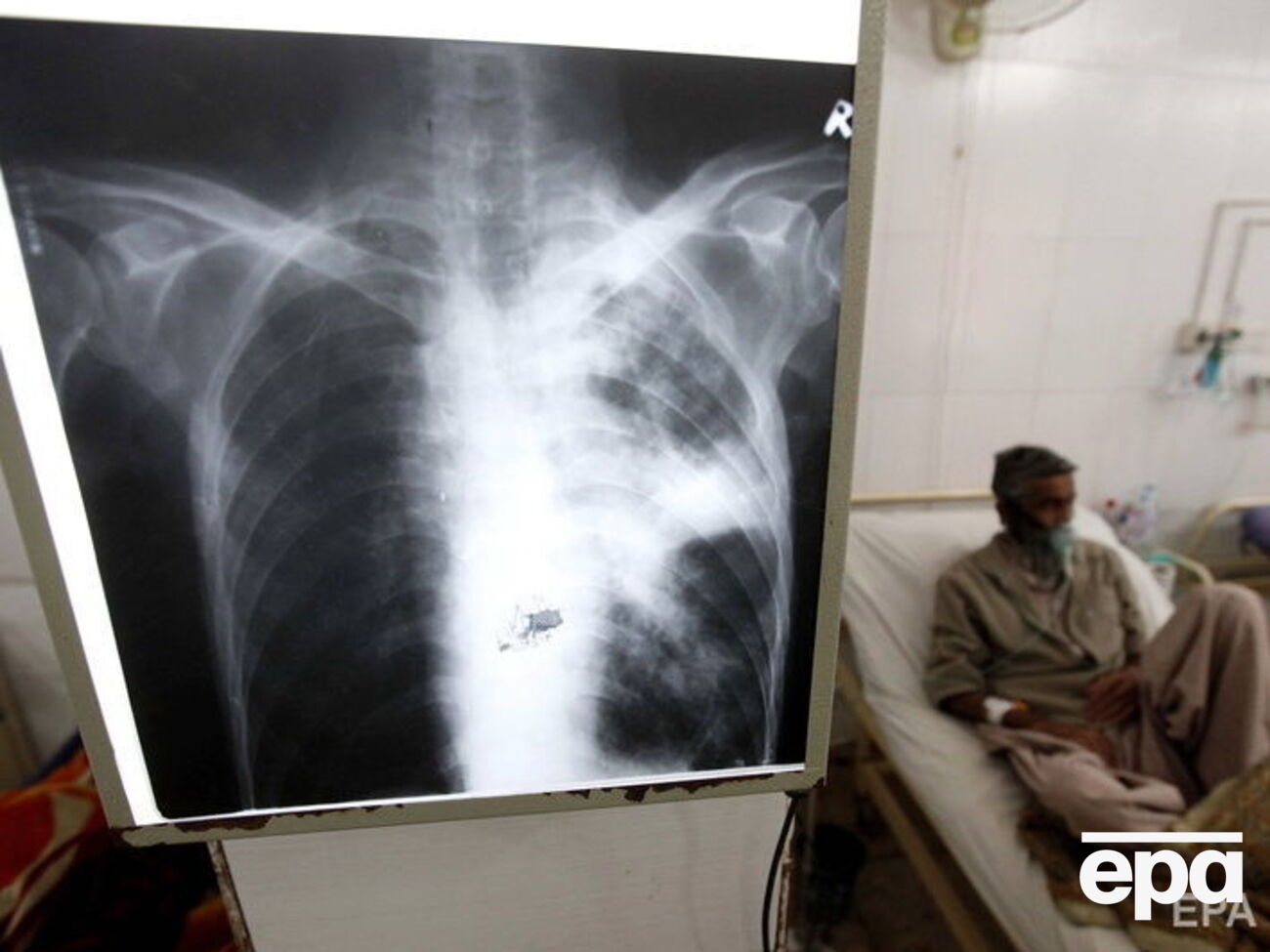 ВОЗ призвала активировать борьбу с туберкулезом