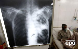 ВОЗ призвала активировать борьбу с туберкулезом