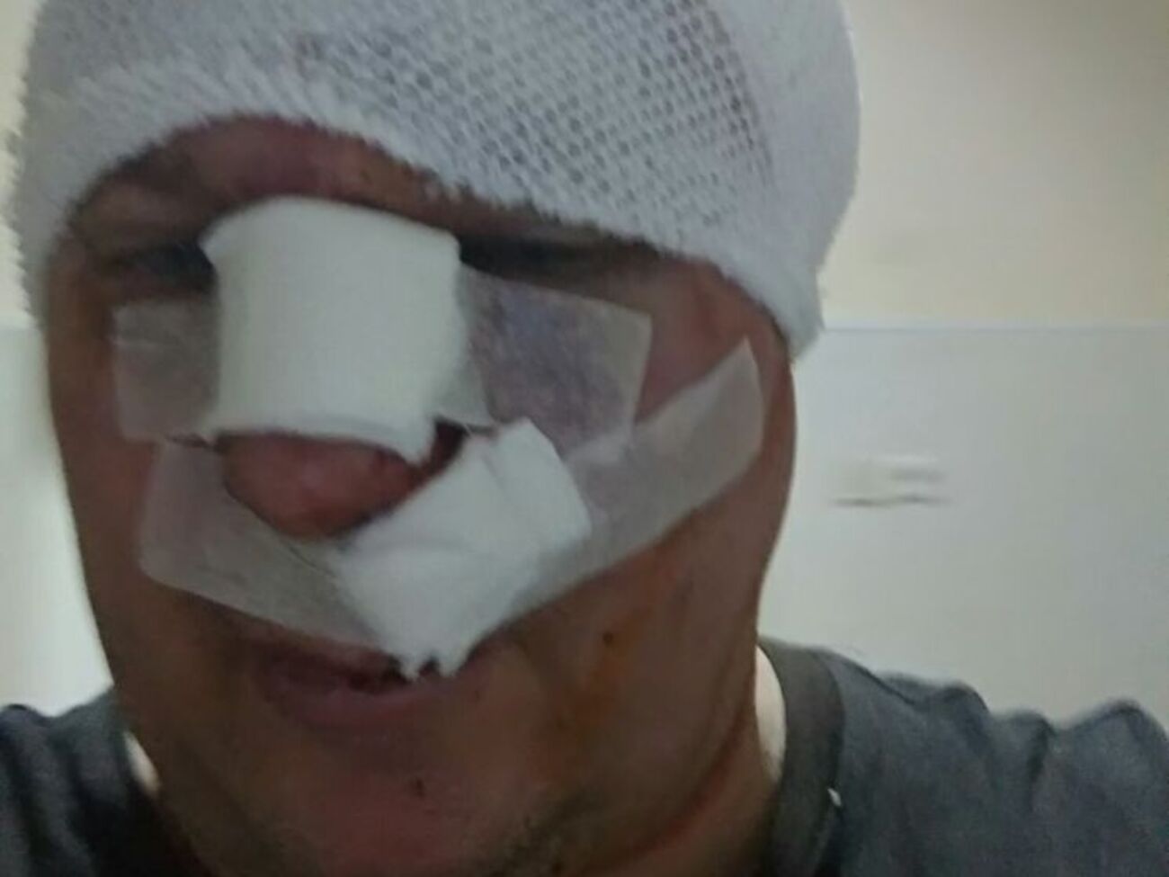 На сторінці Святогора повідомили, що в нього діагностували вдавлений перелом лобної кістки