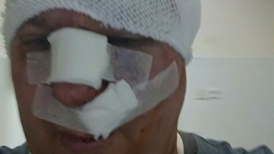 На сторінці Святогора повідомили, що в нього діагностували вдавлений перелом лобної кістки