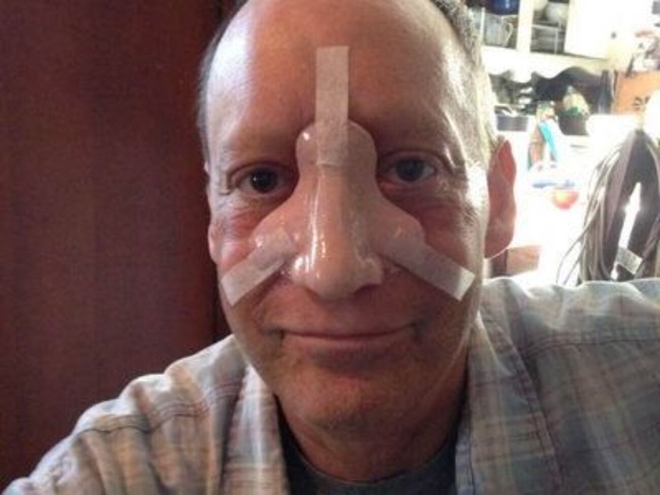 Бін після операції втратив ніс