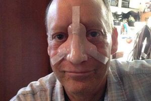 Бін після операції втратив ніс