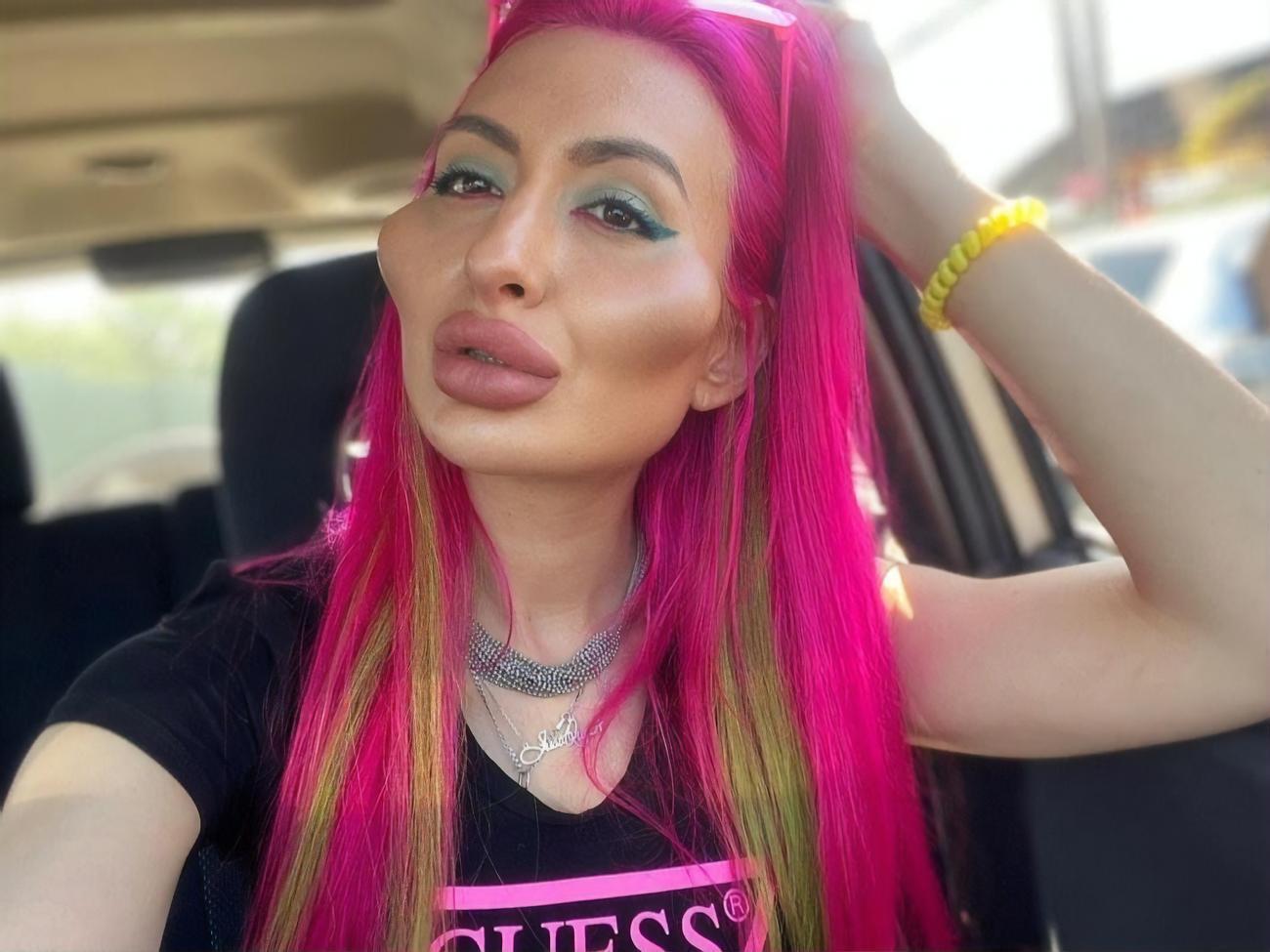 На увеличение скул Покрещук потратила около 60 тыс. грн