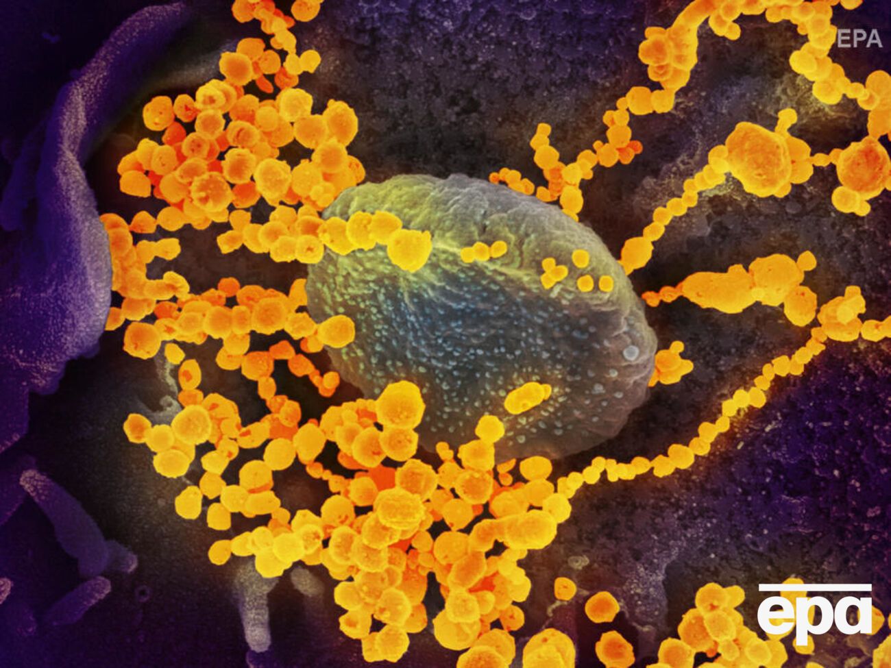 Атаку коронавируса SARS-CoV-2 на клетки человека сняли с помощью микроскопа