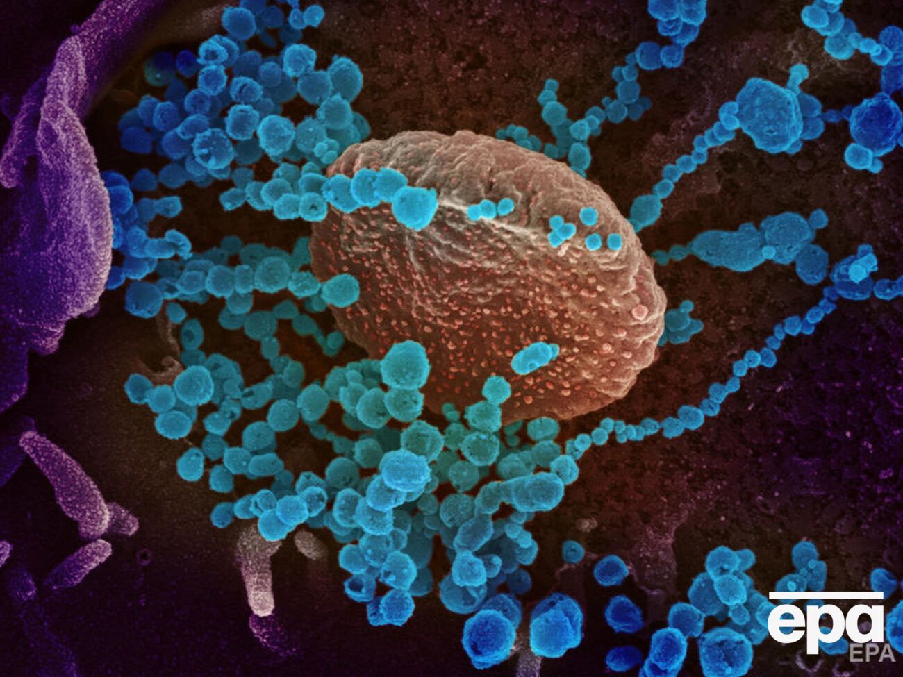 Перший випадок коронавірусної інфекції зареєстровано у Тернопільській області