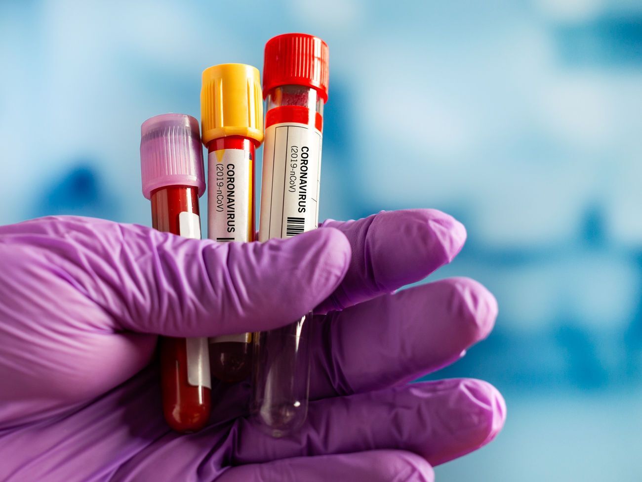 В Украине на утро 20 апреля выявлено 5710 заболевших COVID-19