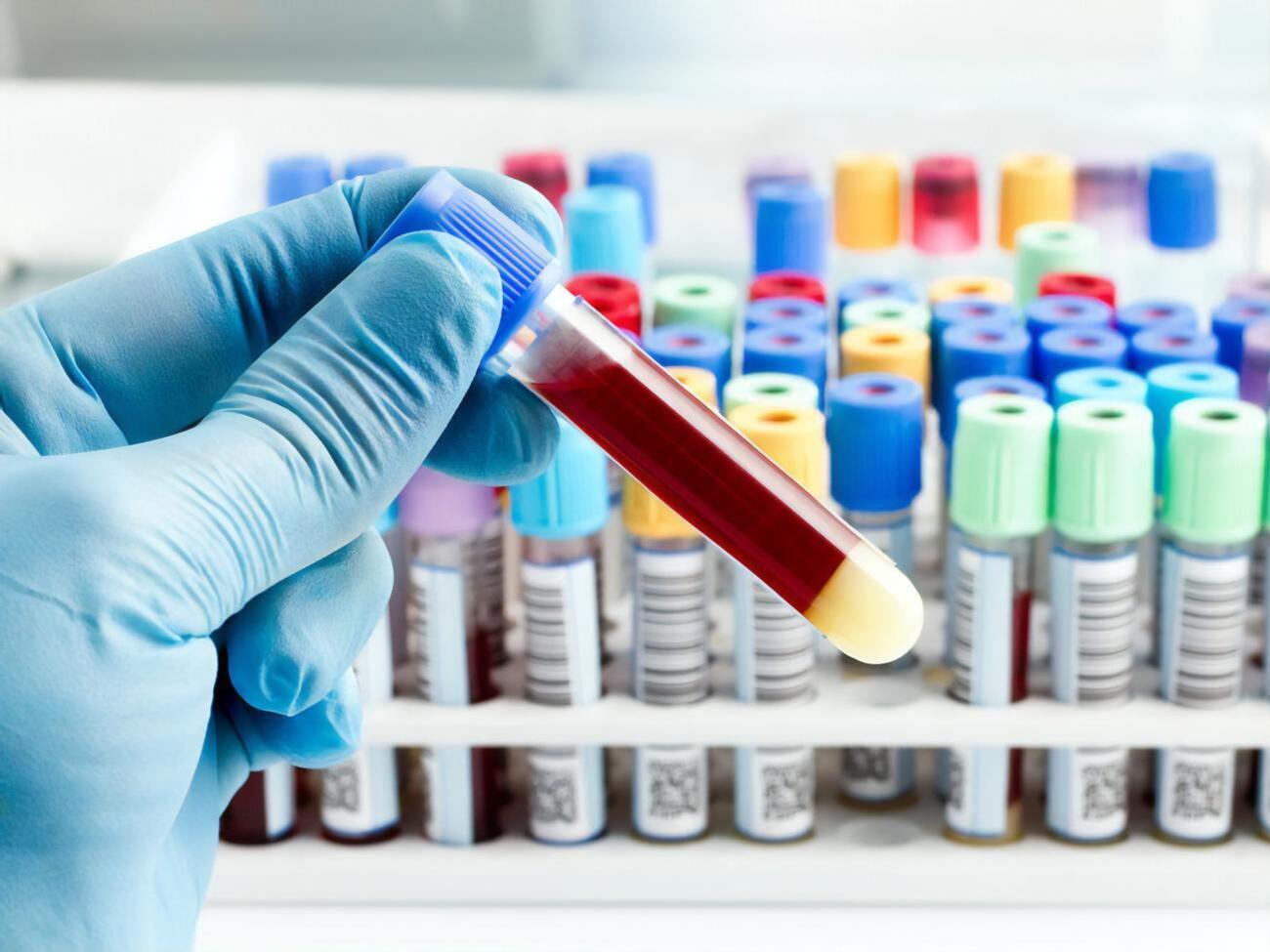 В Украине более 30 тыс. выявленных инфицированных