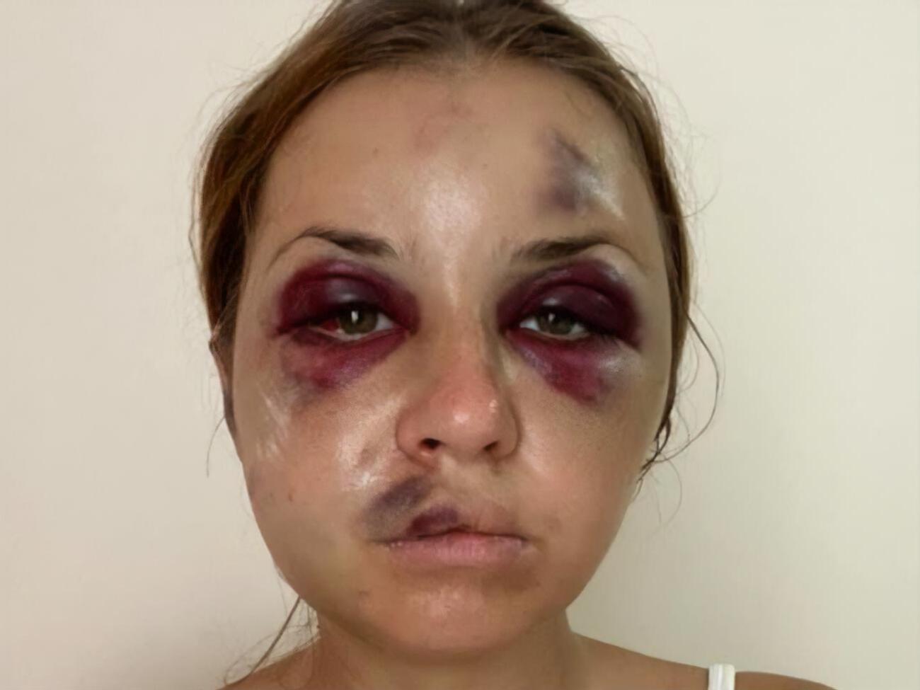 У Лугової після нападу &ndash; численні травми обличчя