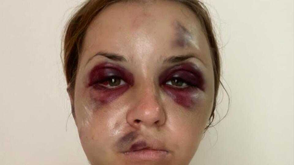 У Лугової після нападу – численні травми обличчя