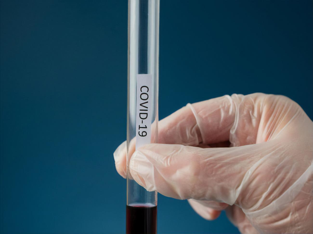 Наразі вважають, що спалах коронавірусної інфекції COVID-19 виник наприкінці 2019 року в китайському місті Ухань