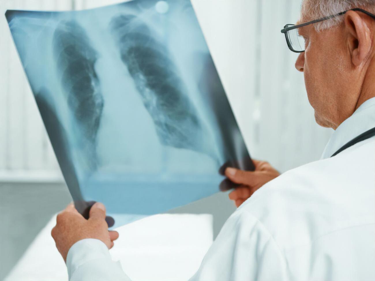 Туберкулез&nbsp;чаще всего поражает легкие человека