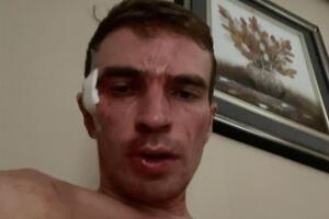 Сообщается, что Мернесу порезали лицо, сломали три зуба, ухо и нос