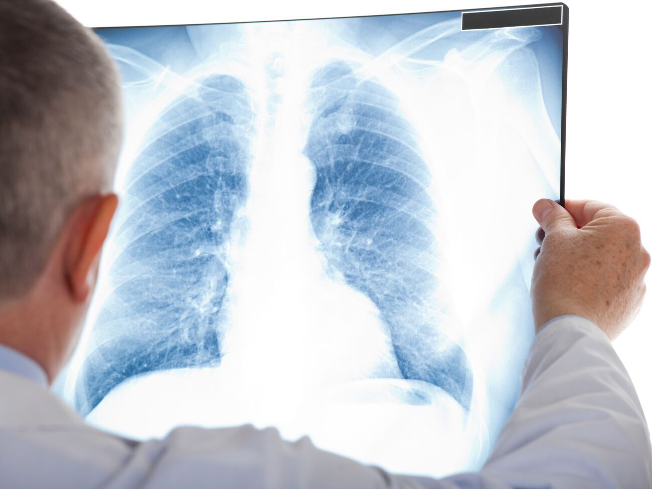 Женщина умерла после&nbsp;трансплантации легких