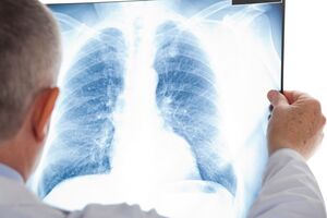 Женщина умерла после трансплантации легких